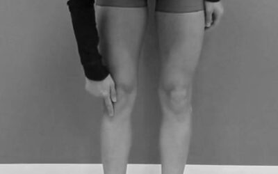 Tibial Tuberosity Continuum Distortion